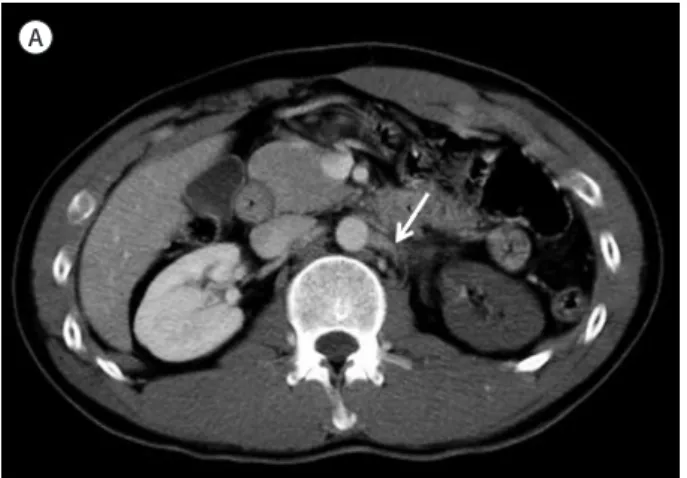 Fig. 2. 27-year-old man with main renal  artery injury struck by an industrial robot.