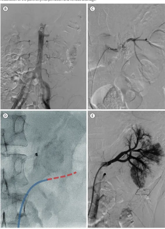 Fig. 2. 27-year-old man with main renal artery injury struck by an industrial robot.