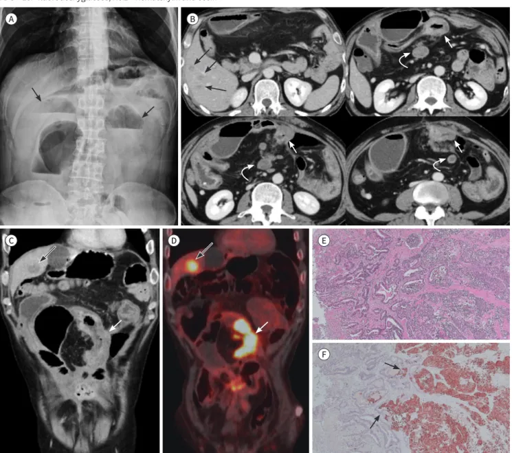 Fig. 1. A 54-year-old man with mixed adenoneuroendocrine carcinoma of the small bowel.