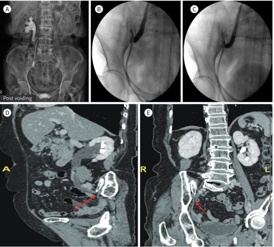 Fig. 1. A 77-year-old patient with unilateral hydronephrosis due to ureteric entrapment within the SIJ