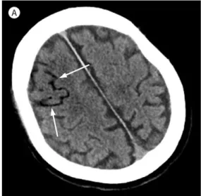 Fig. 1. A 68-year-old man who developed cerebral  air embolism after the removal of a central venous  catheter.