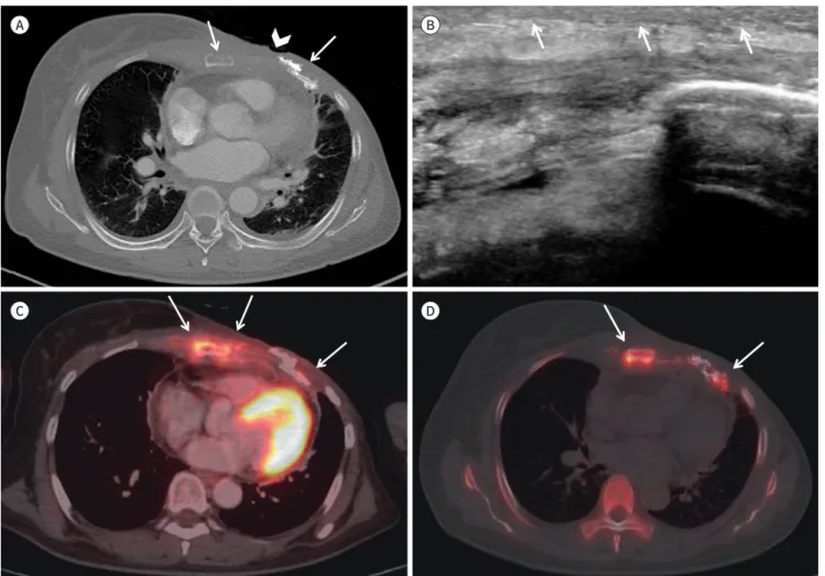 Fig. 1. Radiologic findings of osteoradionecrosis of the ribs and sternum after radiation therapy for breast cancer in a 65-year-old woman.