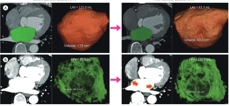 Fig. 3. Changes in LAV and EFV determined with cardiac CT images after catheter ablation of AF
