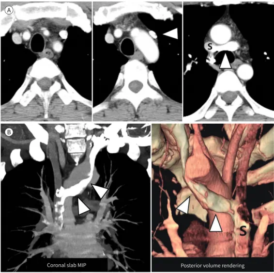 Fig. 3. Subaortic LBCV without a normal LBCV in a 43-year-old man.