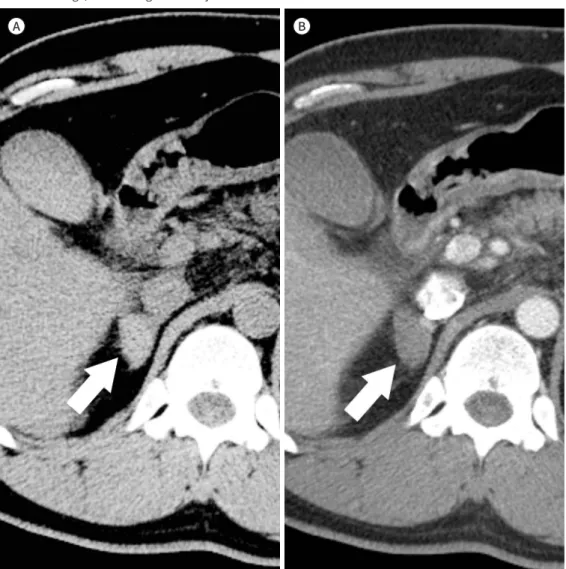 Fig. 6. Adrenal hematoma in the right adrenal gland of a 42-year-old man after a traffic accident