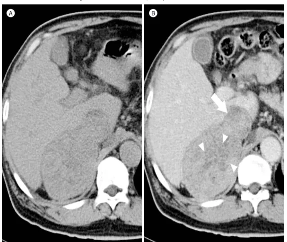 Fig. 12. Adrenal cortical carcinoma in the right adrenal gland of a 61-year-old man.