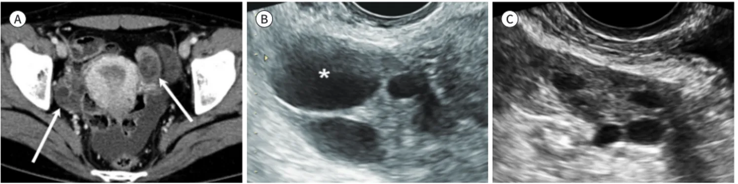 Fig. 2. Normal atrophic ovaries in a 58-year-old postmenopausal woman.