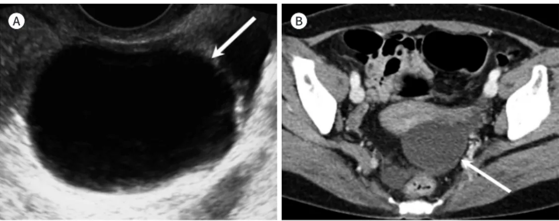 Fig. 3. Ovarian simple cyst in a 63-year-old postmenopausal woman.