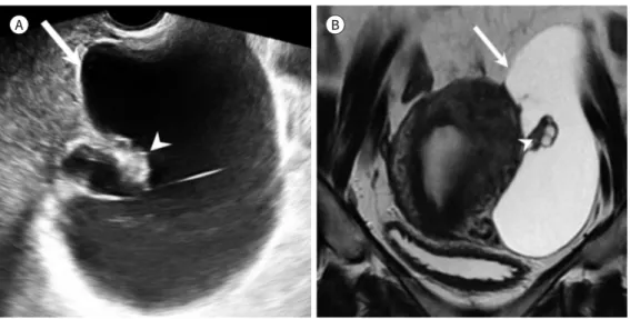 Fig. 6. Peritoneal inclusion cyst in a 43-year-old woman who underwent surgery for endometriosis previ- previ-ously.