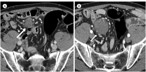 Fig. 1. Desmoid tumor in a 52-year-old man with a past history of an operation performed 7 years ago