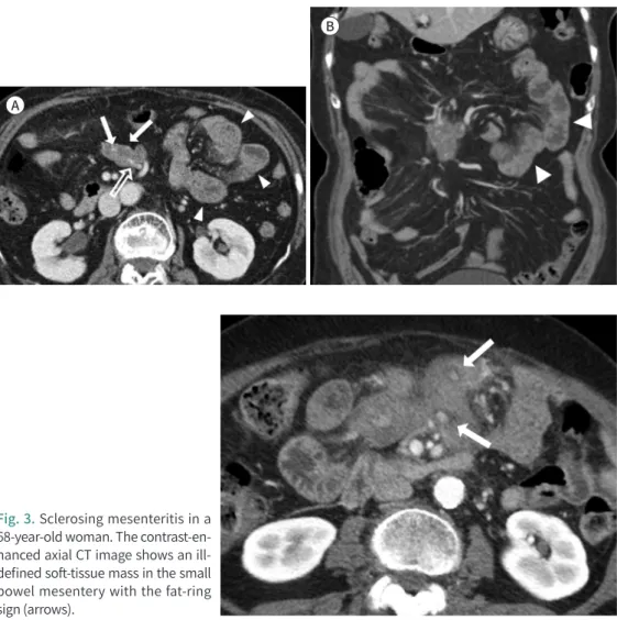 Fig. 3. Sclerosing mesenteritis in a  68-year-old woman. The  contrast-en-hanced axial CT image shows an  ill-defined soft-tissue mass in the small  bowel mesentery with the fat-ring  sign (arrows)