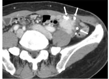 Fig. 12. Tuberculous lymphadenitis with enteritis in a 50-year-old man with active pulmonary tuberculosis  and pleurisy