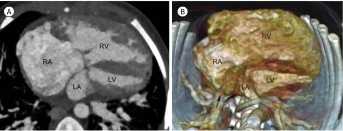 Fig. 6. Cardiac apex formed by the RV in a patient with double outlet RV and a small LV.