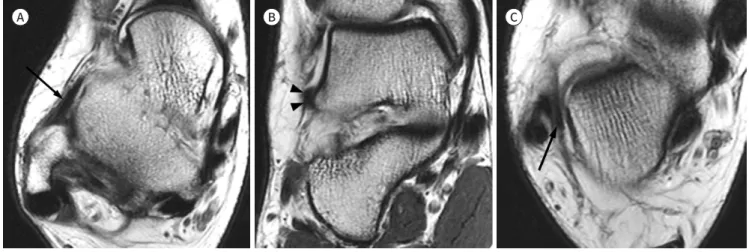 Fig. 2. A 26-year-old woman who underwent the modified Broström procedure for the treatment of chronic lateral ankle instability