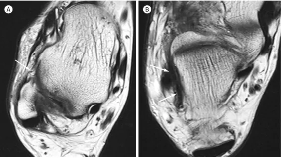 Table 2. Comparison of MRI Features of the Injured Calcaneofibular Ligaments
