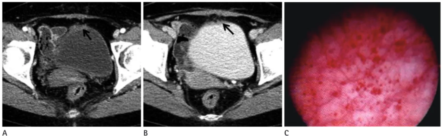 Fig. 1. A 51-year-old woman who had adherent clot in the bladder wall.