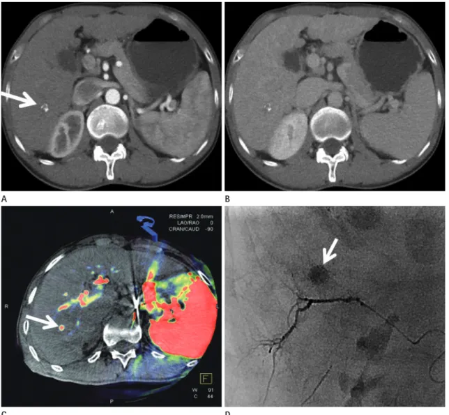 Fig. 2. A 54-year-old male patient who had undergone a single transarterial chemoembolization treatment.