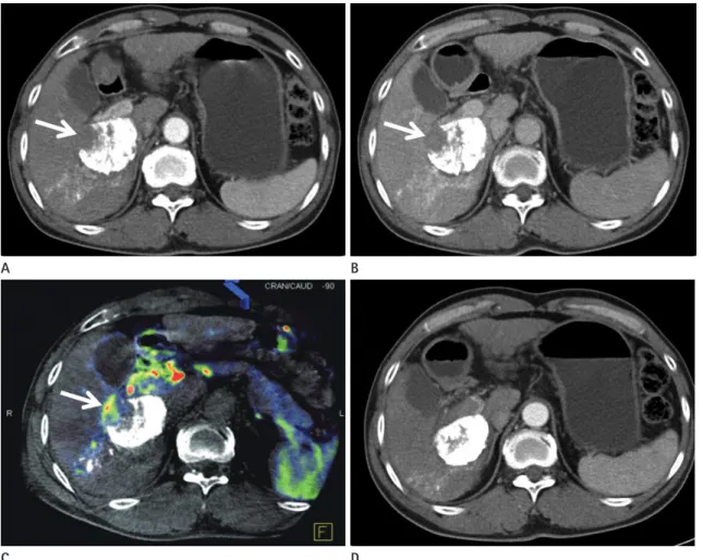 Fig. 3. A 48-year-old male patient who had undergone a single transarterial chemoembolization treatment.