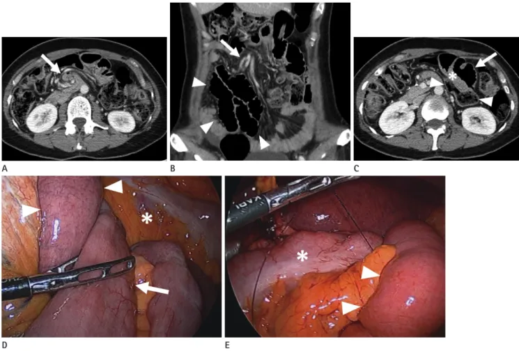Fig. 1. Petersen’s hernia in a 37-year-old woman.