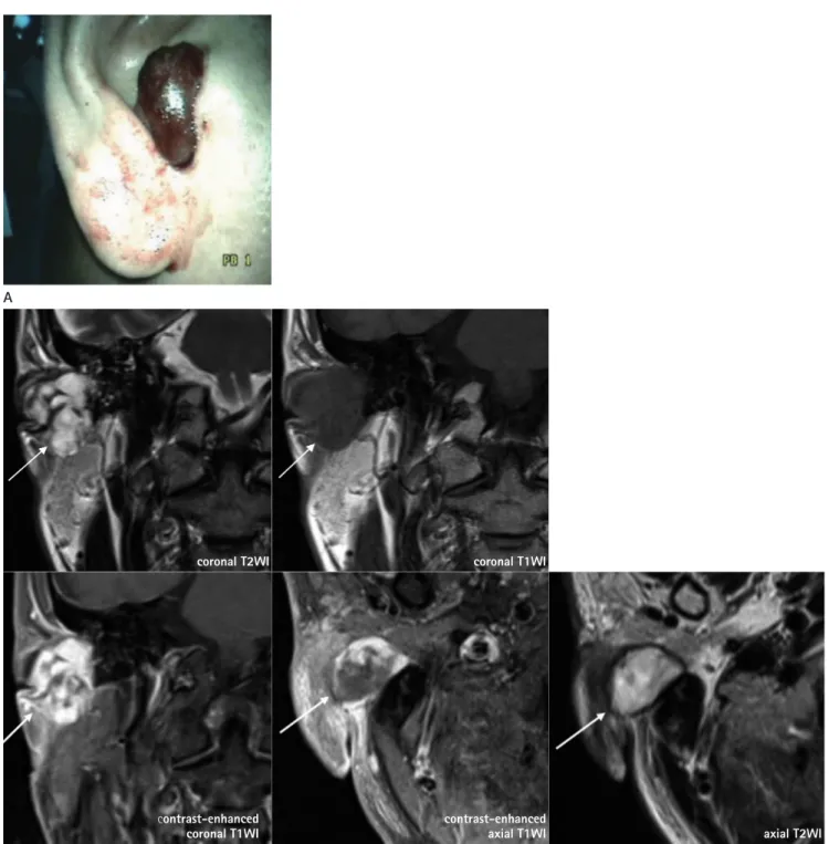 Fig. 1. An isolated myxoma in the external auditory canal in a 59-year-old man with a growing mass within the right external auditory canal.