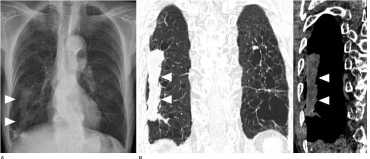 Fig. 2. Pneumonia with underlying emphysema in a 79-year-old man.