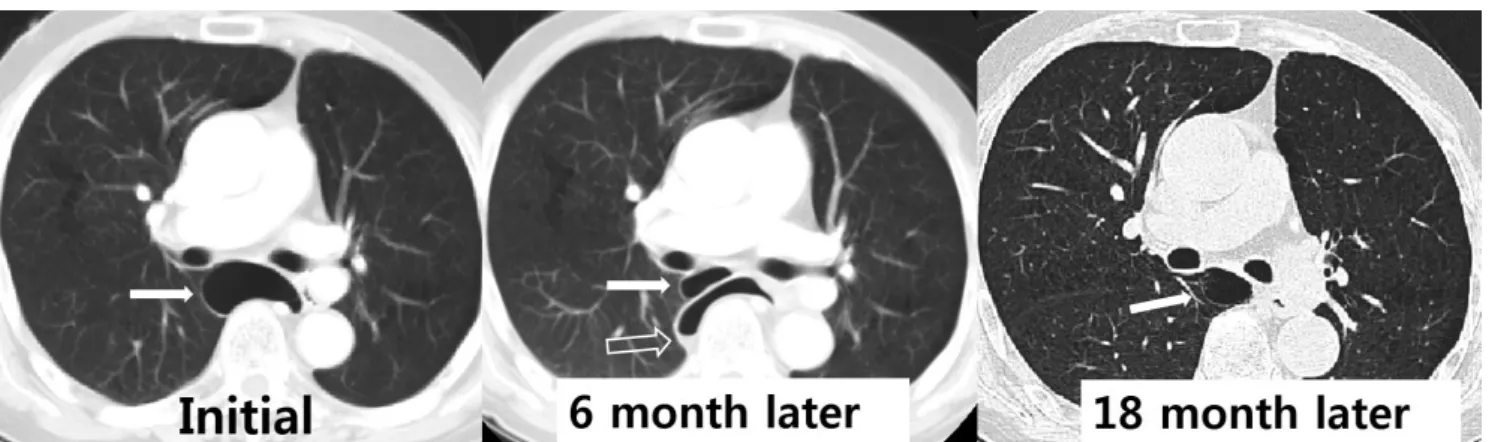 Fig. 6. The sequential change in bulla by infection in a 64-year-old man. Initial CT image shows a bulla (arrow) at the right azygoesophageal re- re-cess
