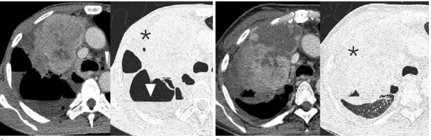 Fig. 11. Changes in bullae by degree of respiration in an 87-year-old man. Bullae (arrows) in both lower lobes have markedly decreased in expira- expira-tion view