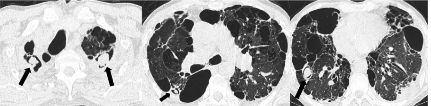 Fig. 12. Multiple aspergillomas in a bulla in a 59-year-old man. Serial axial images show multiple aspergillomas (arrows) with air crescent signs  in the right lung and the left upper lobe