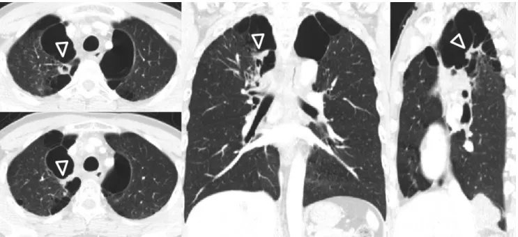 Fig. 15. Lung cancer developing in a bulla in a 79-year-old man. CT images show irregular wall thickening (arrowheads) in a bulla in the right upper  lobe