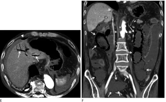 Fig. 1. Acute aortic thrombosis following capecitabine chemotherapy in a 63-year-old man with colon cancer.