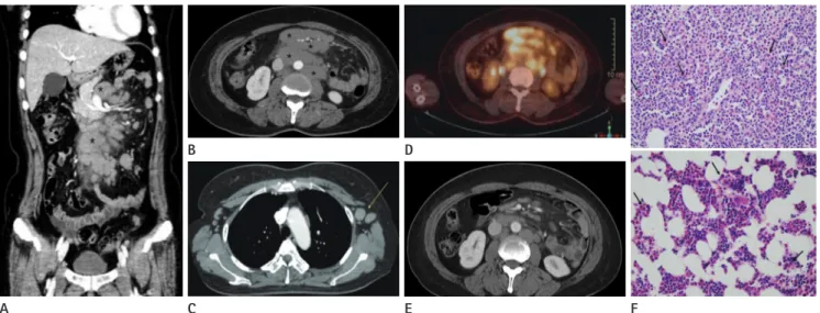 Fig. 1. A 43-year-old female with multiple lymph node enlargements detected in abdomen and pelvis CT