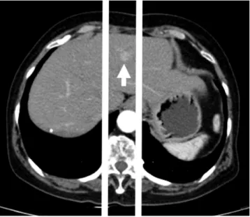 Fig. 4. Location of tumor is marked (arrow) as either right, middle, and  left with reference to the vertebral column