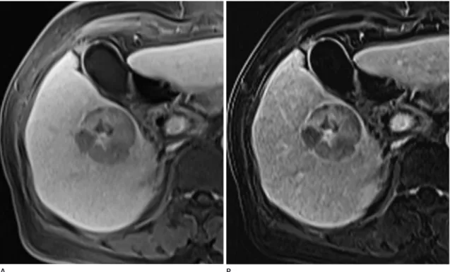 Fig. 1. Case of a 73-year-old woman with hepatocellular carcinoma encased by a histopathologically confirmed fibrous capsule in the right liver