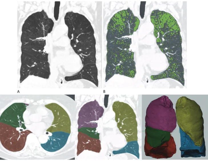 Fig. 1. Quantitative CT measurement of emphysema.