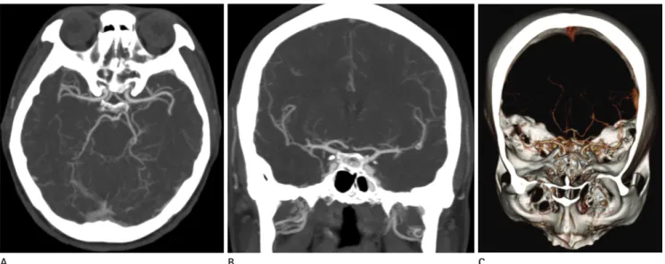 Fig. 1. Cerebral CTA of 38-year-old woman, using the fixed 120-kVp protocol. Axial (A) and coronal (B) maximum intensity projection images  with a slab thickness of 10 mm and volume rendering image (C) were assessed