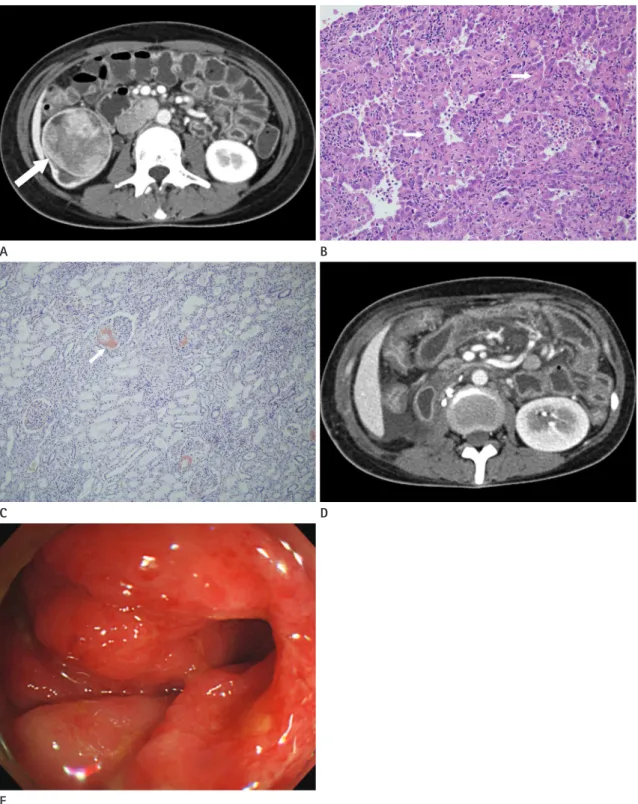 Fig. 1. A 21-year-old woman of systemic amyloidosis secondary to RCC.