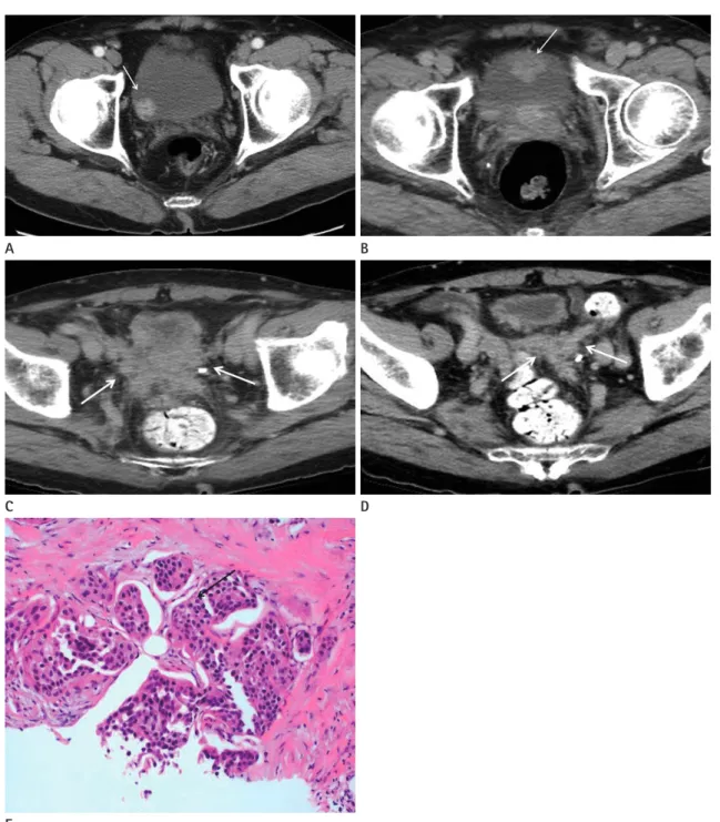 Fig. 1. Initial contrast-enhanced CT image in a 70-year-old man.