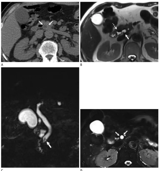 Fig. 3. A 81-year-old male, suspected with cholecystitis and false positive MRCP findings of choledocholithiasis