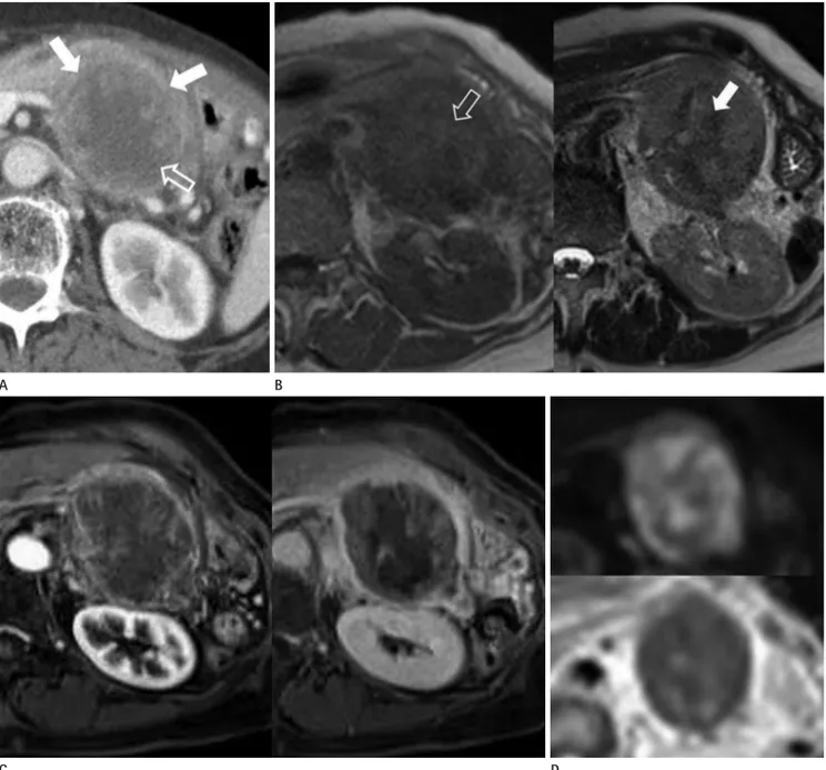Fig. 1. A 75-year-old female patient presented a pancreatic solid pseudopapillary neoplasm with high-grade malignant transformation.