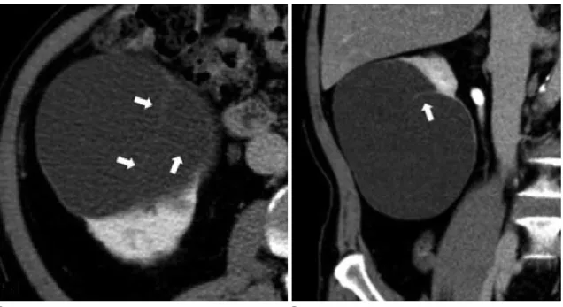 Fig. 3. A 71-year-old man with a Bosniak classification II lesion in the right kidney and he was performed two times ethanol injections