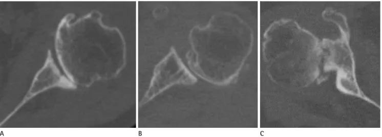Fig. 5. Walch classificiation of glenoid wear. On the left, centered hu- hu-meral head with minor (Walch type A1) or major (Walch type A2)  cen-tral erosion is demonstrated