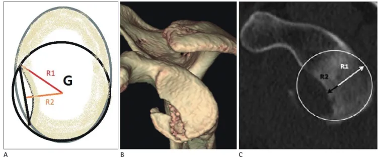 Fig. 9. Measurement of the Hill-Sachs lesion. Volume-rendered (A), axial shoulder computed tomography (B) images show a Hill-Sachs lesion  (arrows)