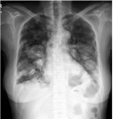 Fig. 1. A 60-year-old woman with pulmonary metastasis from uterine  sarcoma, presenting as multiple nodules with tortous, serpentine,  an-eurysmal dilated intraumor vessels.