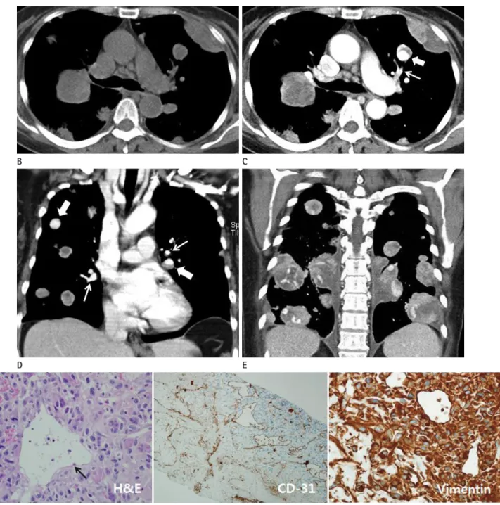 Fig. 1. A 60-year-old woman with pulmonary metastasis from uterine sarcoma, presenting as multiple nodules with tortous, serpentine, aneu- aneu-rysmal dilated intraumor vessels.