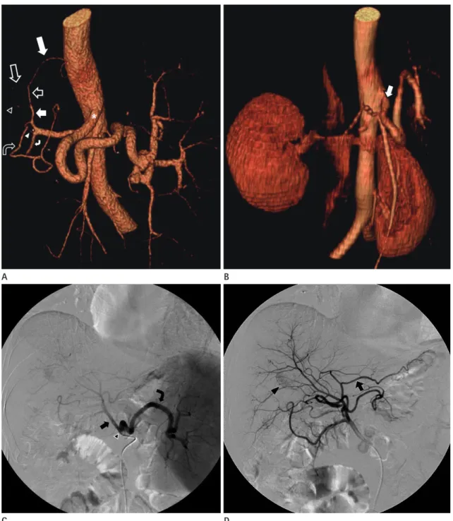 Fig. 1. A 62-year-old male patient with entirely replaced LGA from the LHA, confirmed on liver CT and conventional angiography.