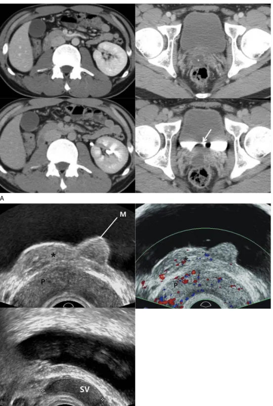Fig. 1. A 23-year-old male presented with history of urinary retention and dysuria.