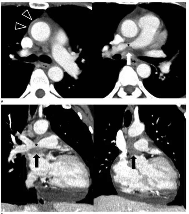 Fig. 10. Constriction of the right pulmonary artery by chronic pericarditis in a 47-year-old woman.