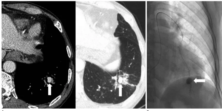 Fig. 14. Aneurysm of the peripheral pulmonary artery in a 66-year-old man who was treated 20 days earlier for pneumonia