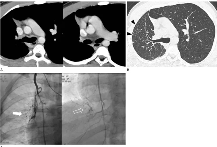 Fig. 1. Interruption of the right pulmonary artery in an 18-year-old man.