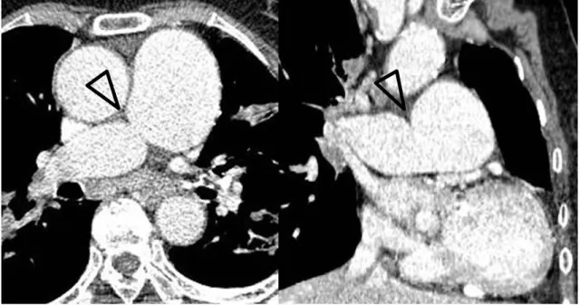 Fig. 2. Constriction of the right pulmonary artery in an 85-year-old woman. Axial and coronal images show focal narrowing of the upper wall of  the proximal right pulmonary artery (open arrowheads)